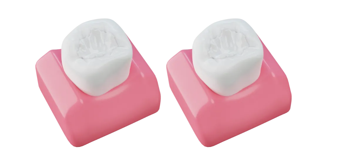 przekr&oacute;j zęba z ubytkiem i opatrunkiem tymczasowym