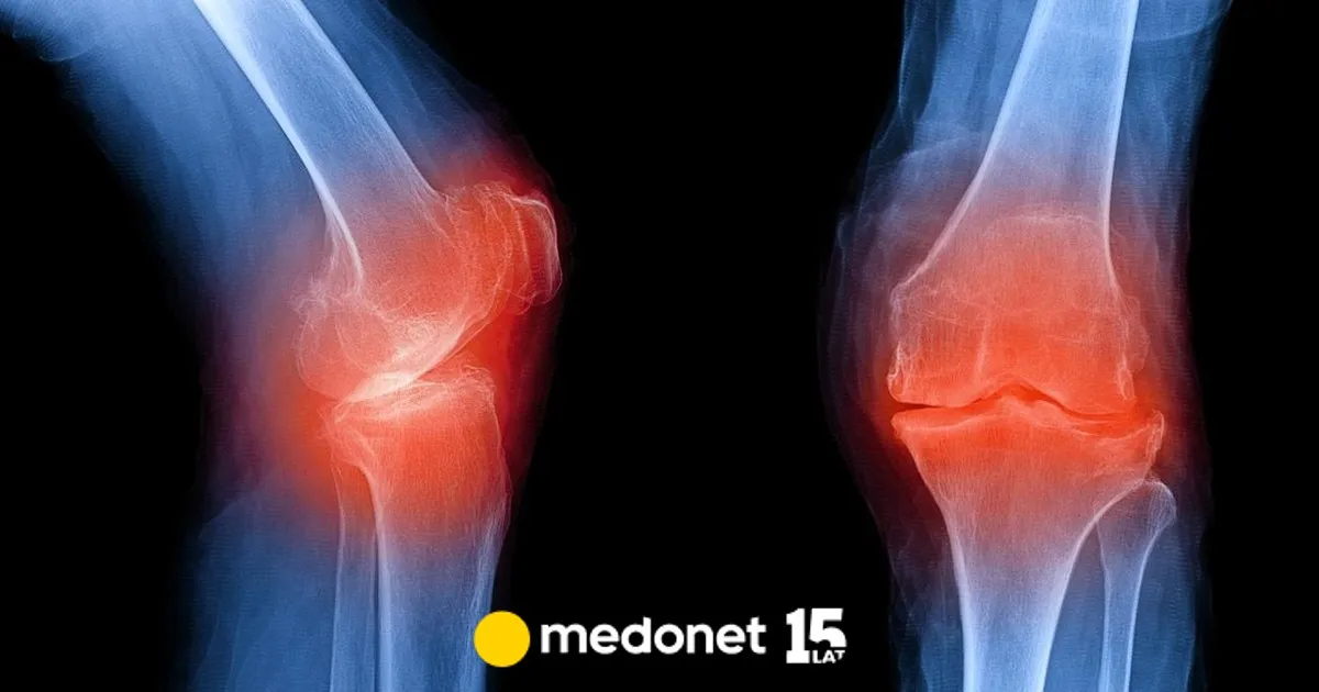 Zdjęcie Osteofitoza jaka rehabilitacja: skuteczne metody łagodzenia bólu stawów