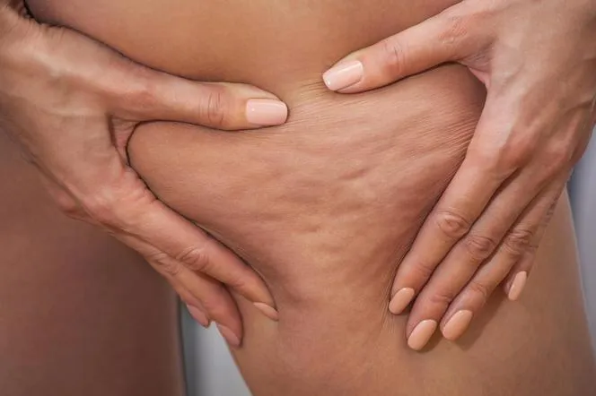 Zdjęcie Skuteczne metody, które naprawdę pomogą pozbyć się cellulitu na zawsze