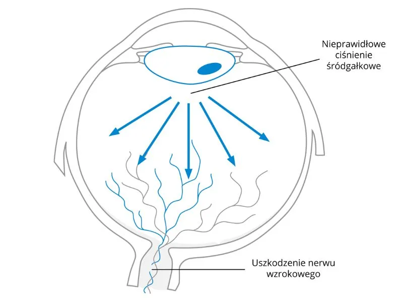 Zdjęcie Czy jaskrę się operuje? Poznaj metody i ryzyko operacji