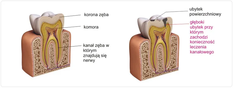 Zdjęcie Ile kanałów ma ząb 6 i jak to wpływa na leczenie kanałowe?