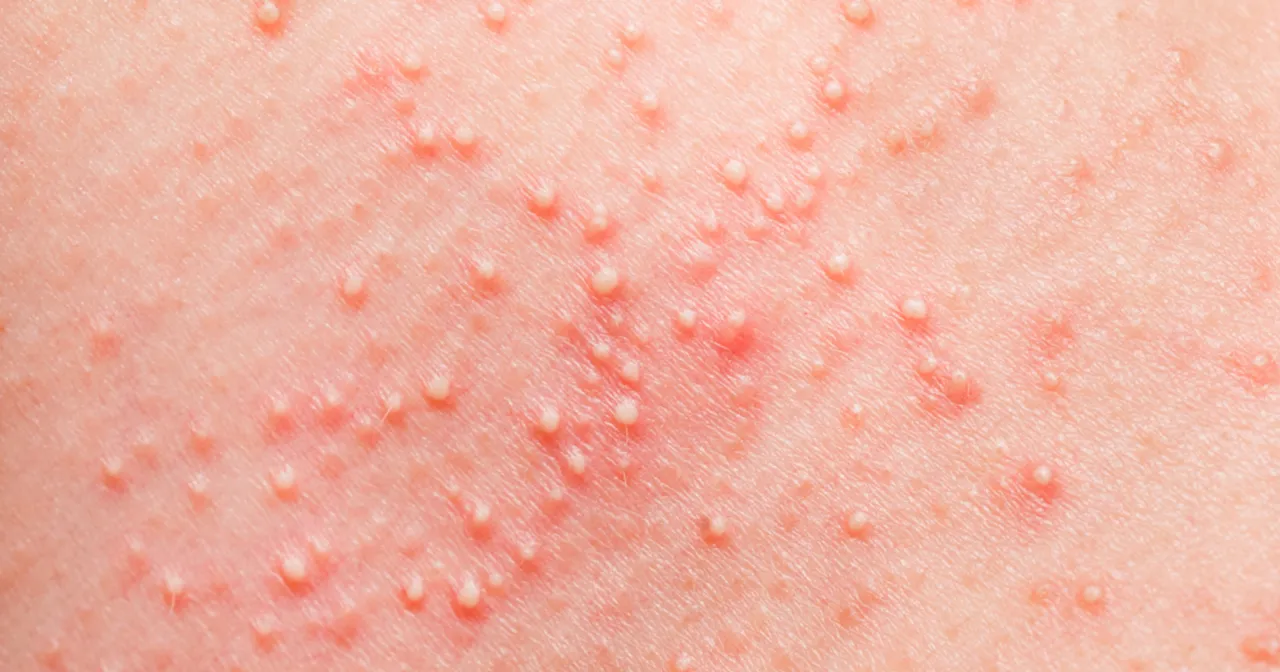 Potówki u niemowlaka na karku i plecach