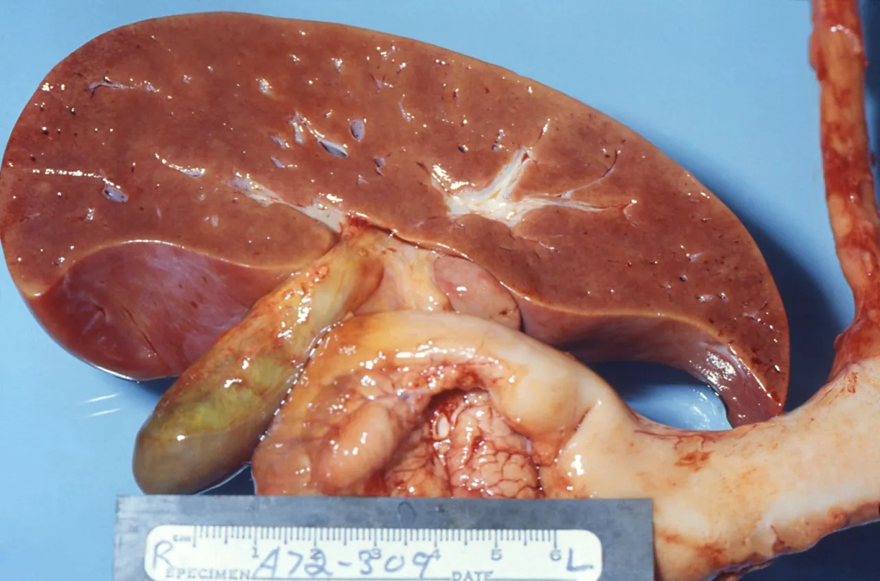 Zesp&oacute;ł Reye'a grafika medyczna