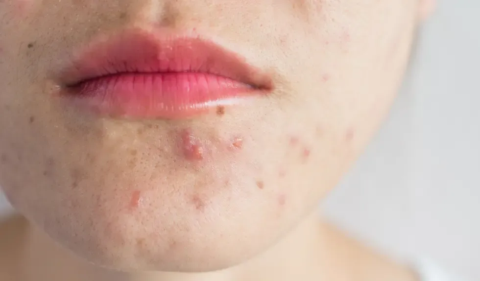 korektor na strupy po pryszczach