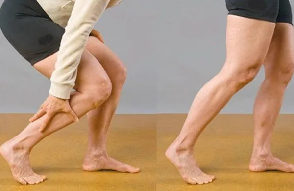 Osoba z b&oacute;lem n&oacute;g podczas chodzenia