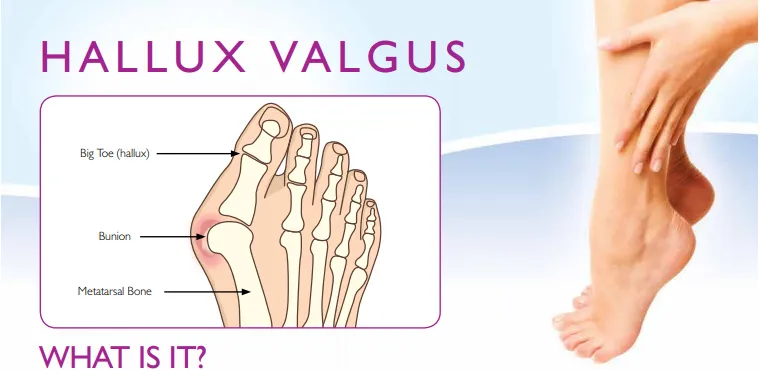 diagram stopy z haluksem i stanem zapalnym