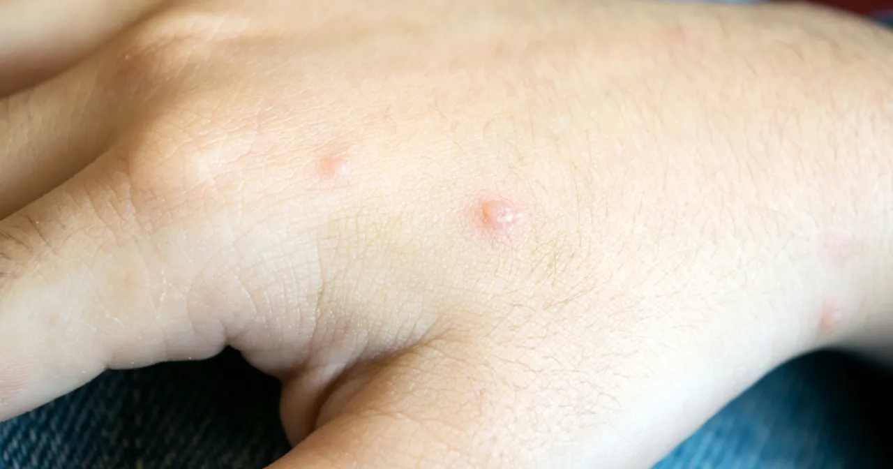 Drobne pęcherzyki na skórze dłoni, objaw bostonki u dzieci.
