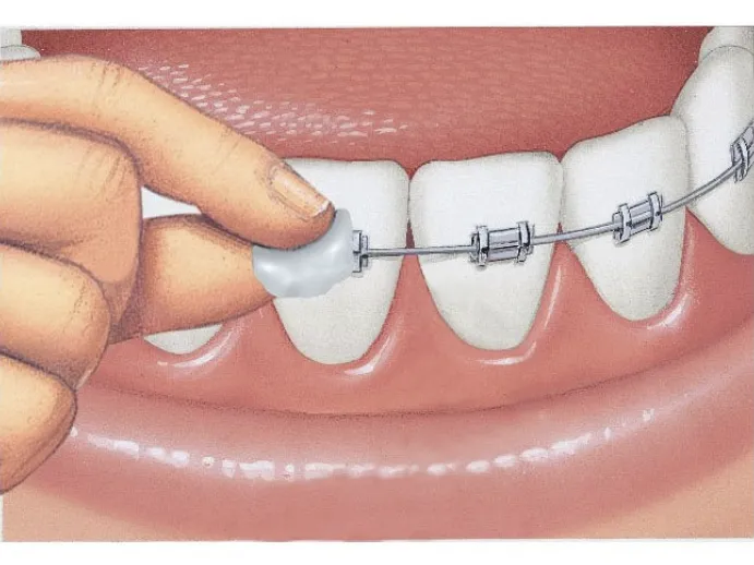 Wosk ortodontyczny na aparacie
