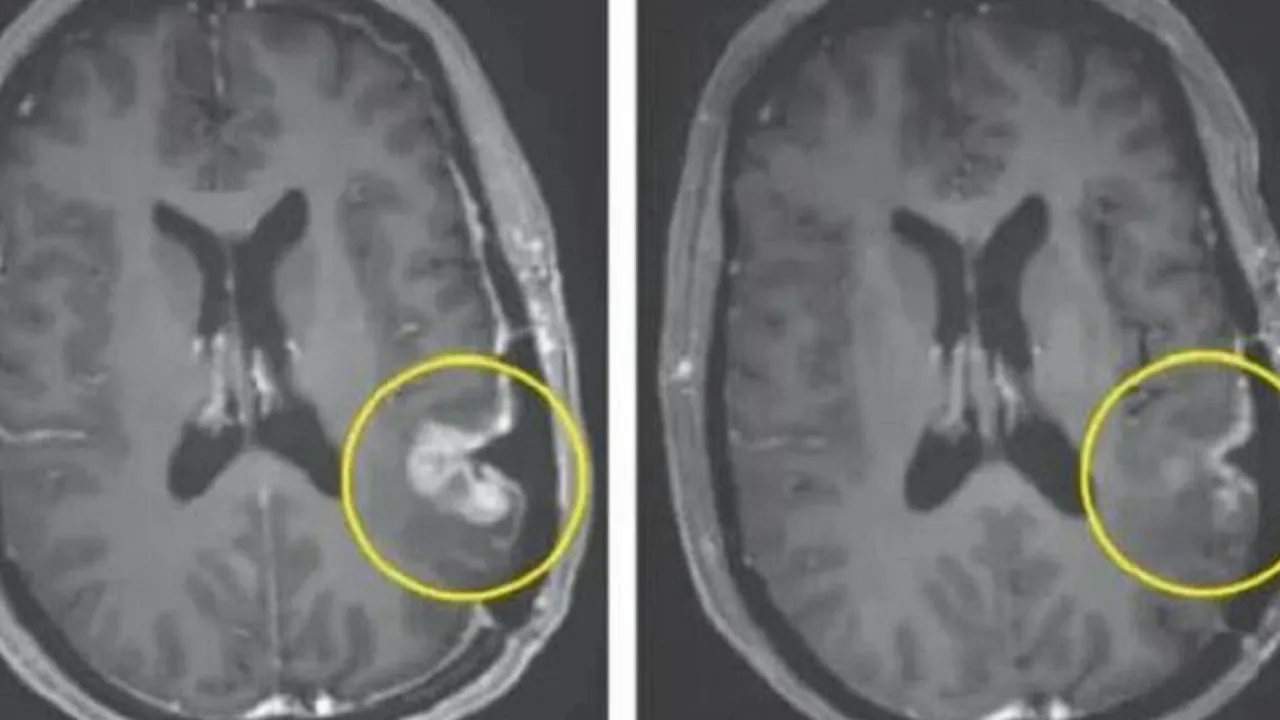 Tomografia komputerowa głowy guz mózgu