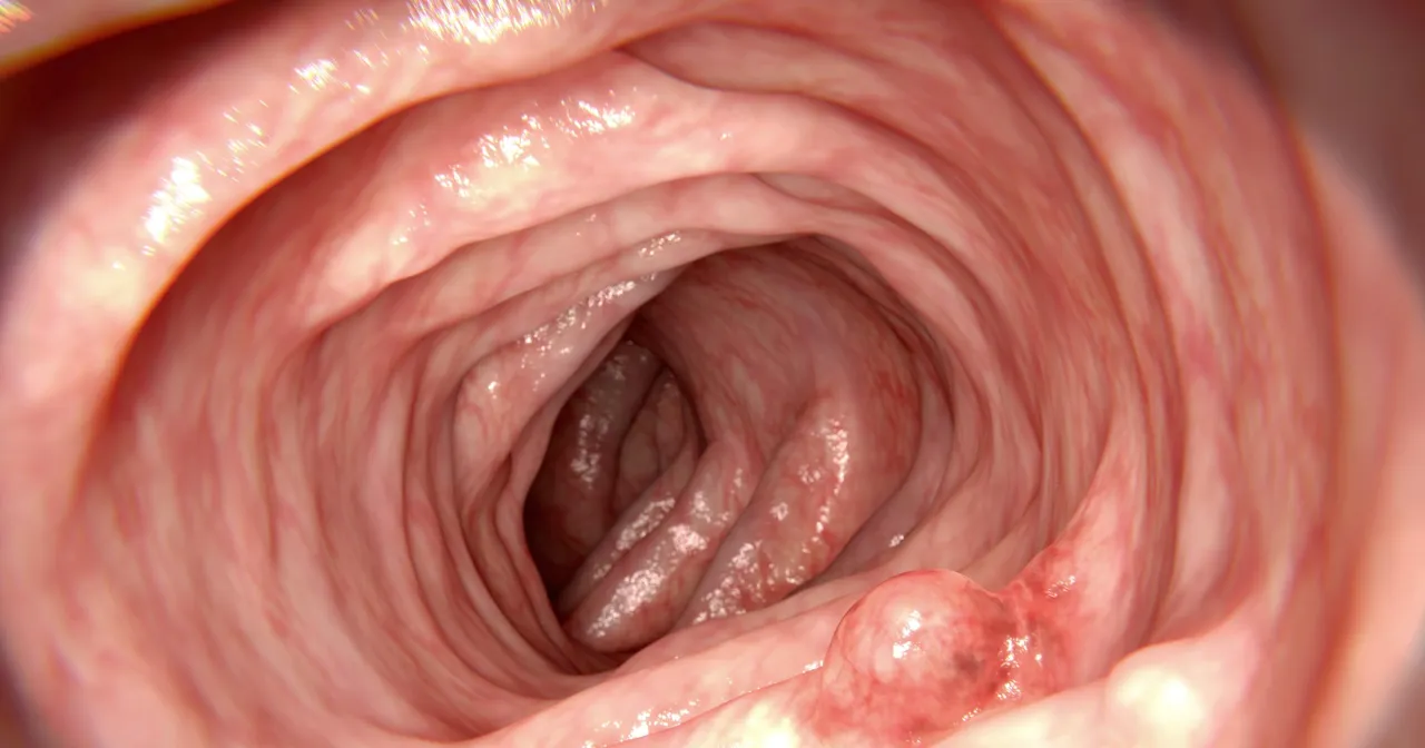 Objawy polip&oacute;w jelita grubego