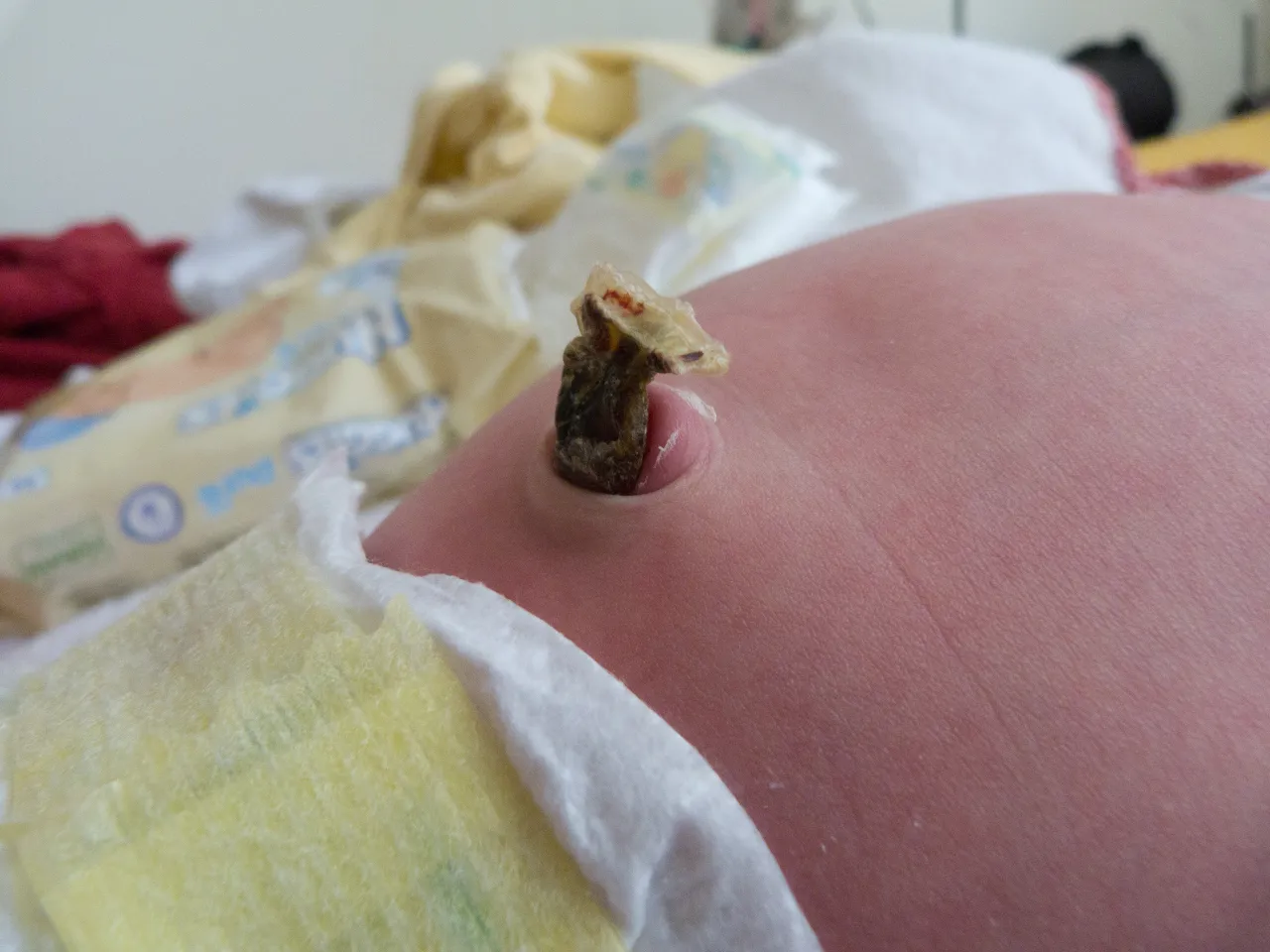 zakażenie pępka noworodka objawy