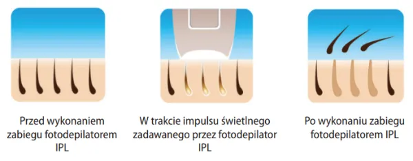 IPL technologia depilacji schemat