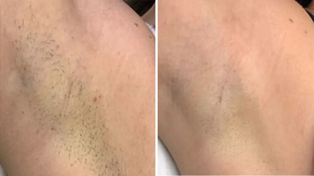 depilacja laserowa pachy przed i po