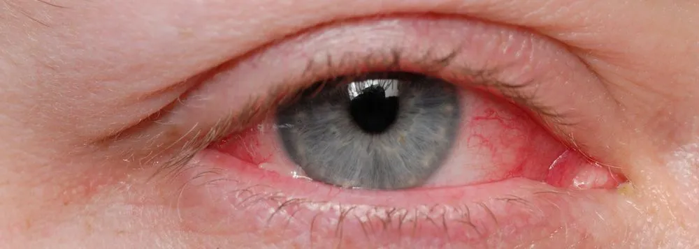 objawy infekcji oka zaczerwienienie b&oacute;l