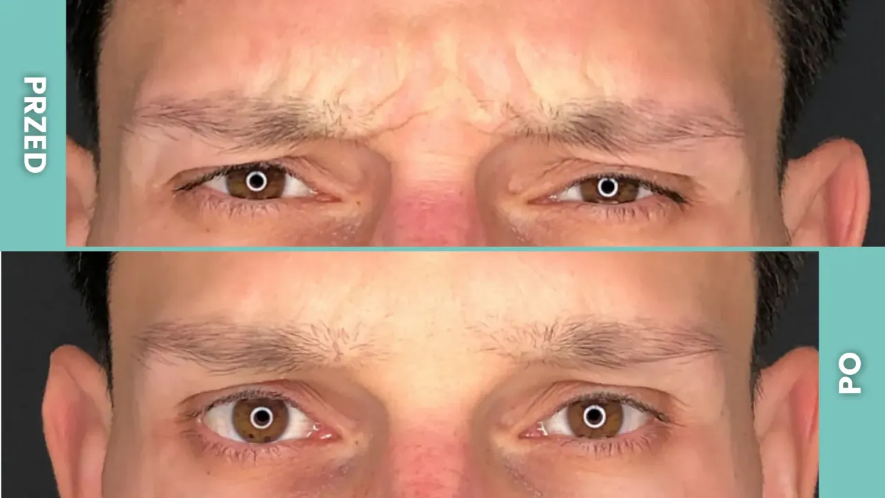 Przed i po zabiegu botoksem. Zmarszczka lwia wygładzona, efekty widoczne po kilku dniach.