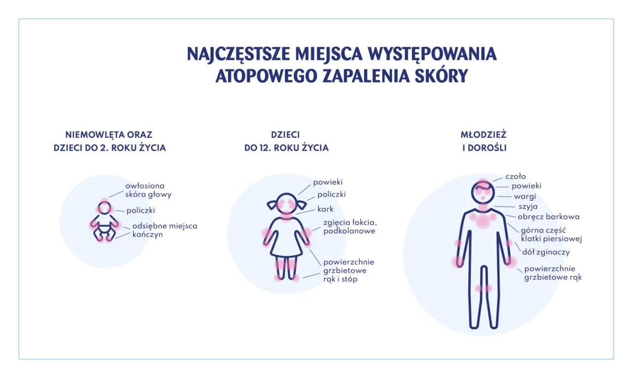 Sk&oacute;ra atopowa mikroskop, gen filagryny