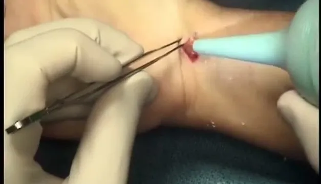 zesp&oacute;ł cieśni nadgarstka operacja endoskopowa