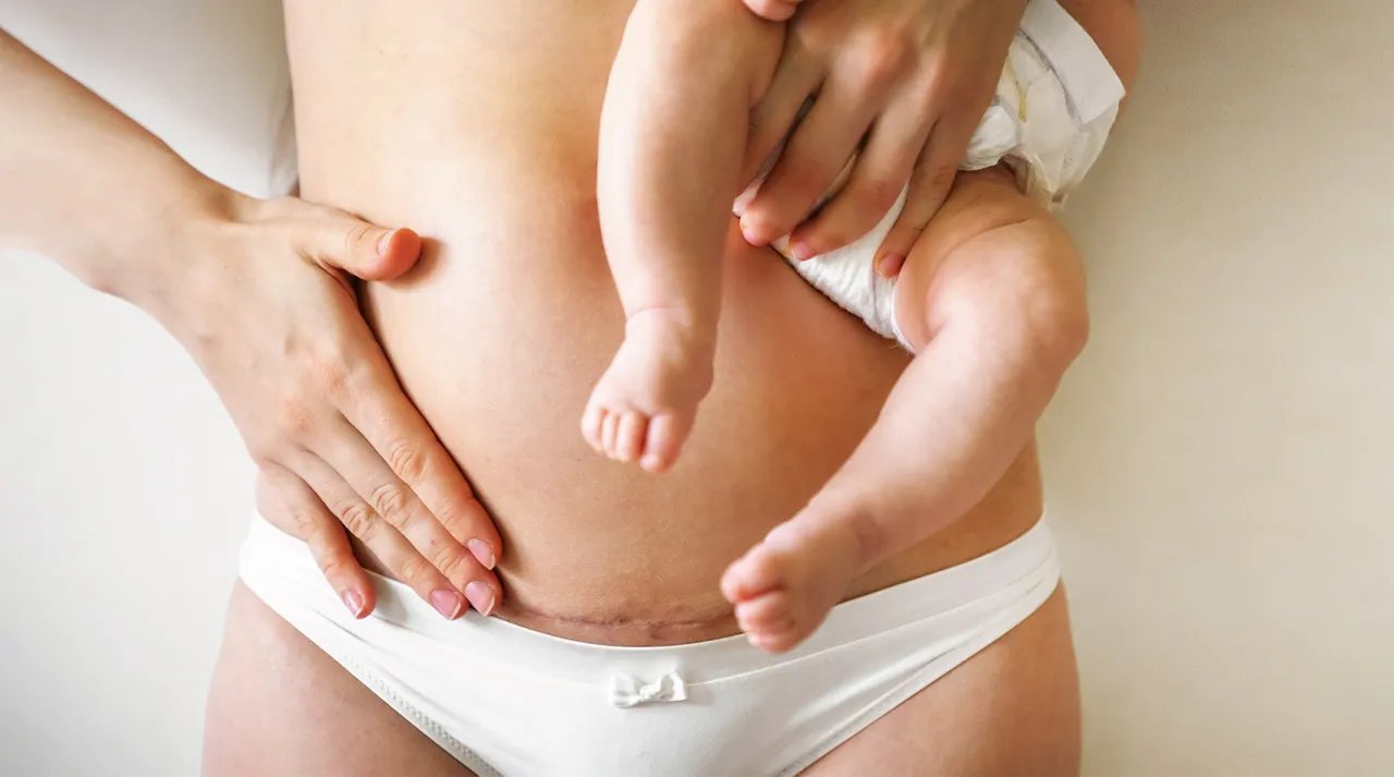 Kobieta po cesarskim cięciu, fizjoterapeuta