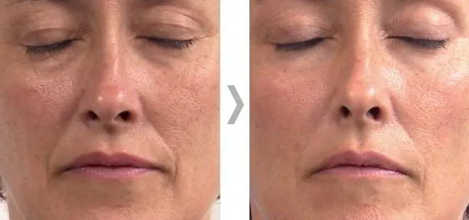 Endermologia twarzy przed po