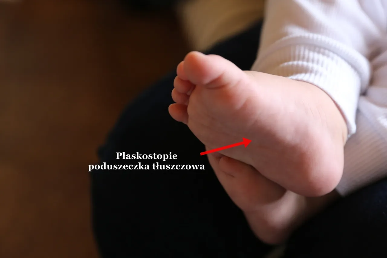 stopa dziecka płaskostopie fizjologiczne poduszka tłuszczowa