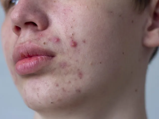 Zdjęcie Masz pryszcze pod brodą? Jak pozbyć się ich raz na zawsze? Rady