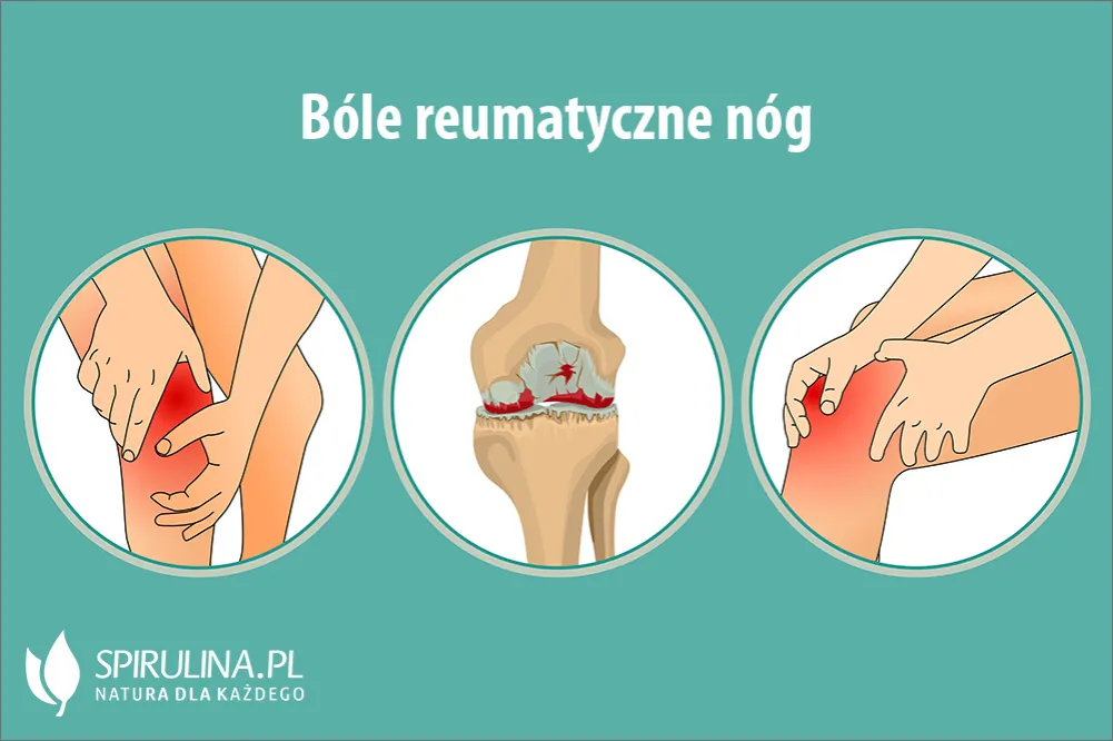Zdjęcie Bóle reumatyczne nóg objawy - jak rozpoznać i złagodzić ból
