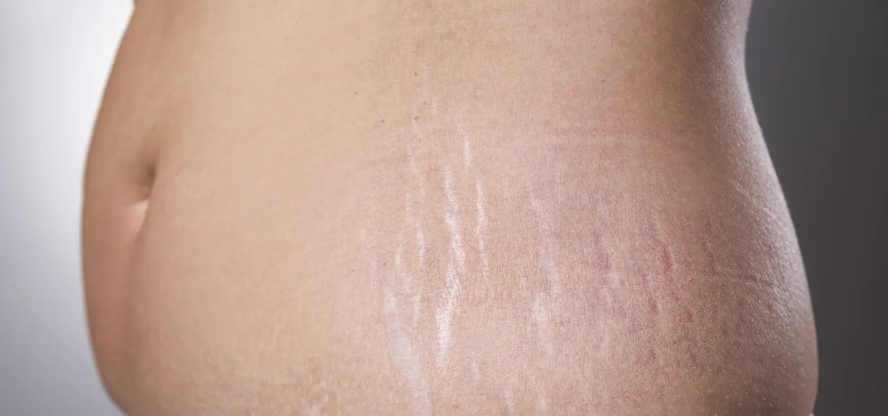 rozstępy na skórze fazy rozwoju