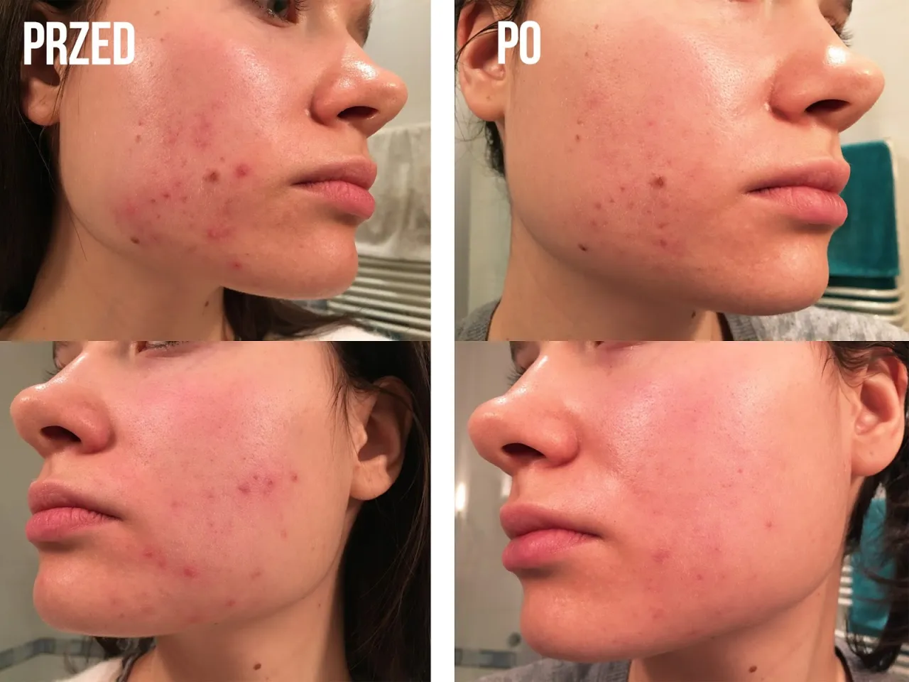 typy cery kwas laktobionowy