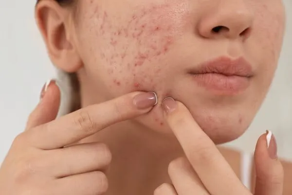 blizny po wyciskaniu pryszczy, konsekwencje wyciskania trądziku