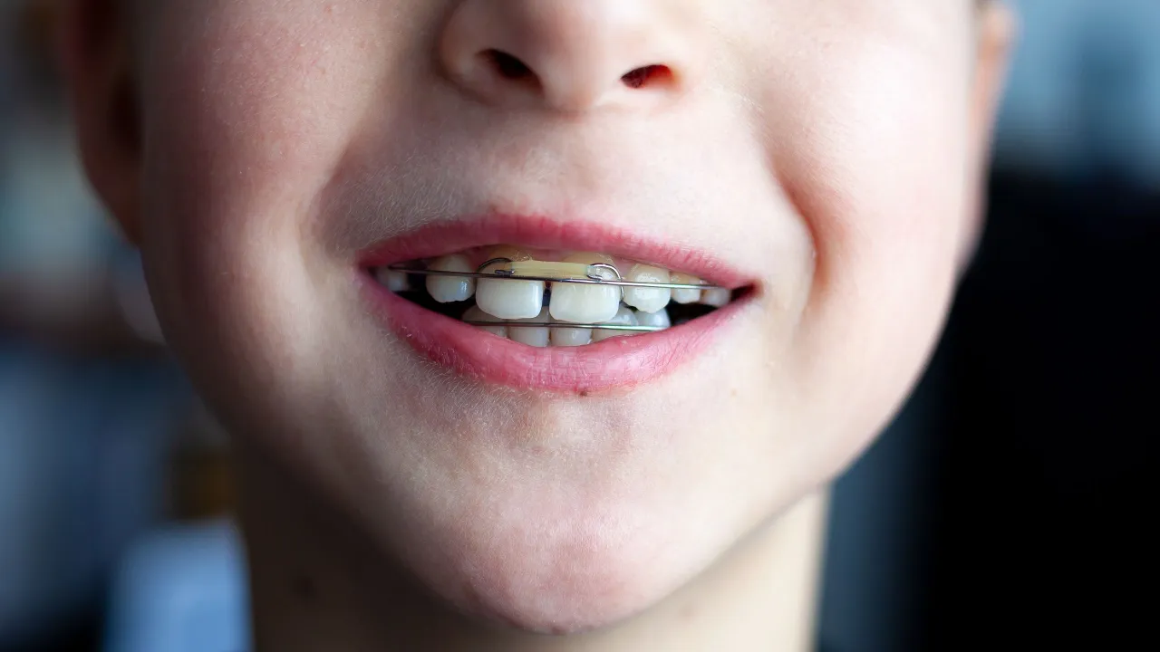 aparat stały dla dzieci wygląd