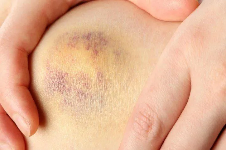 skręcone kolano objawy opuchlizna krwiak