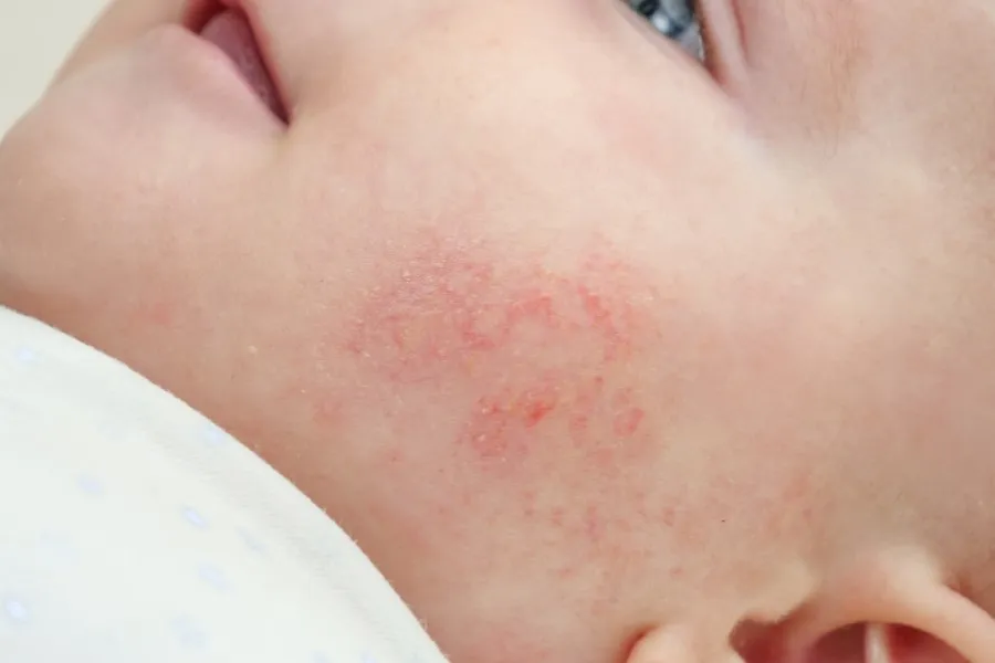 Skaza białkowa niemowlę policzki zdjęcia