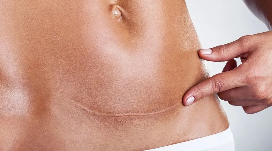 kobieta po cesarskim cięciu delikatne ćwiczenia rekonwalescencja