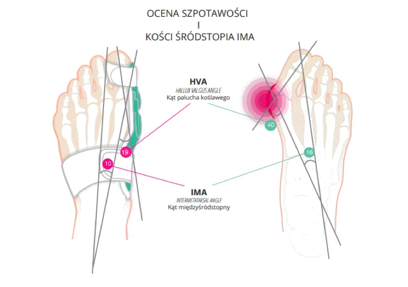 haluksy stopnie zaawansowania