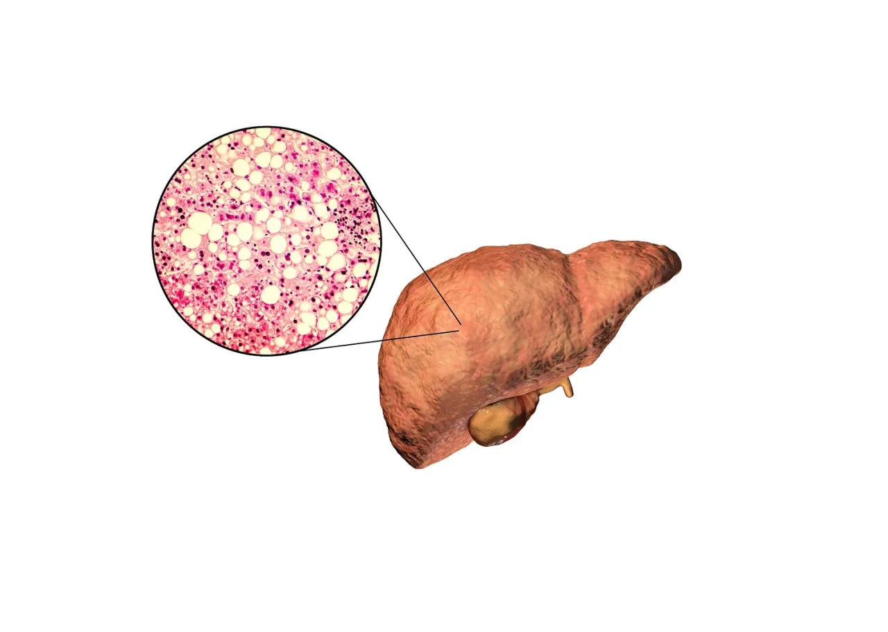 por&oacute;wnanie wątroby zdrowej i stłuszczonej