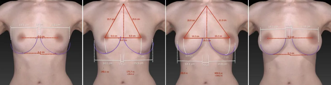przykłady technik cięcia mastopeksji