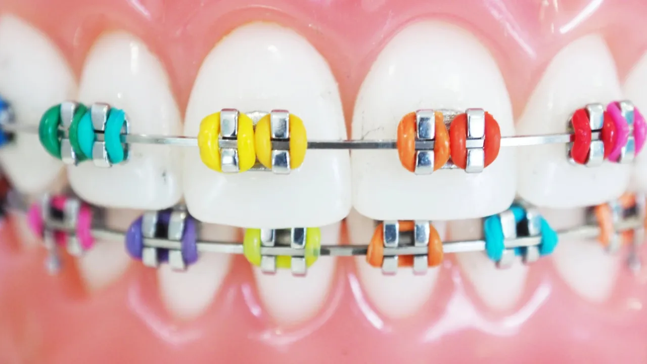 rodzaje zamk&oacute;w ortodontycznych metalowe estetyczne