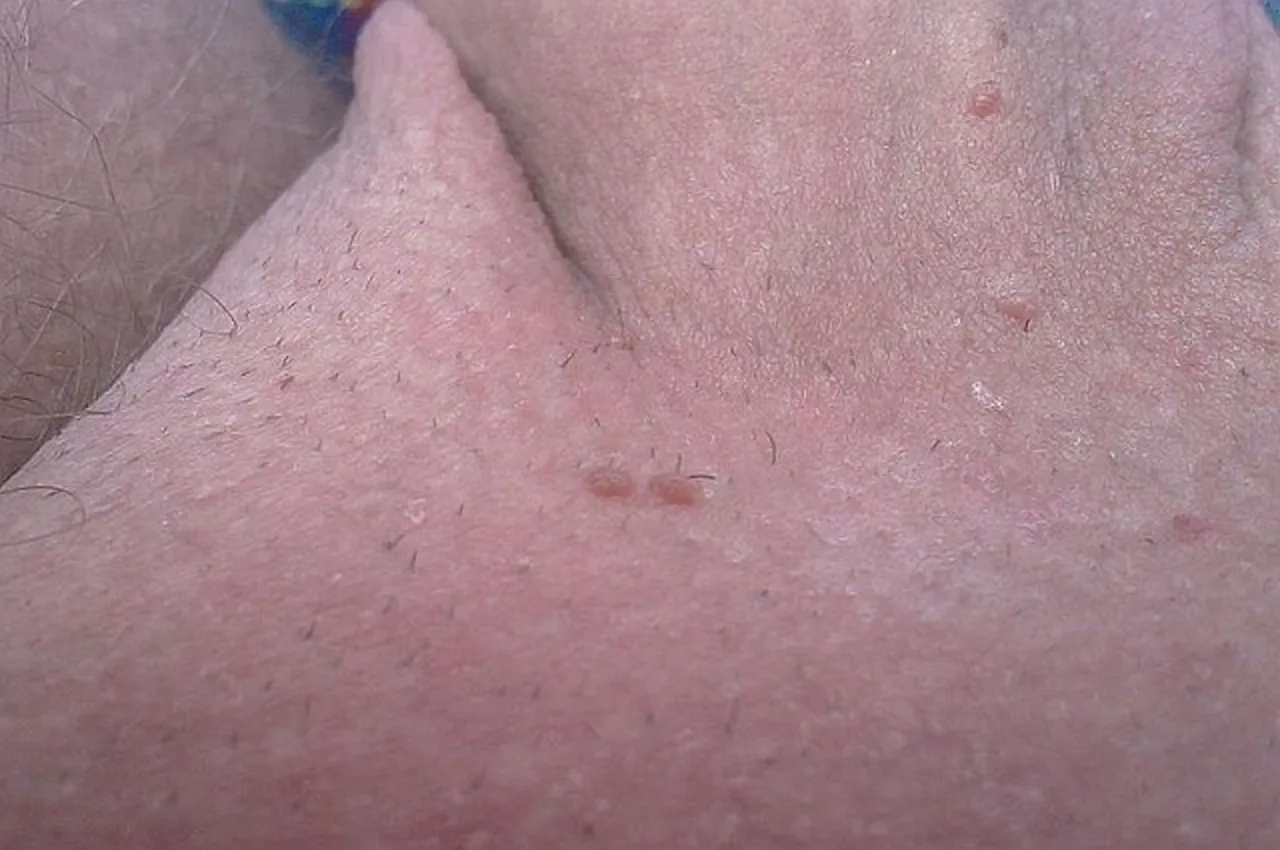 Lekarz dermatolog urolog konsultacja HPV