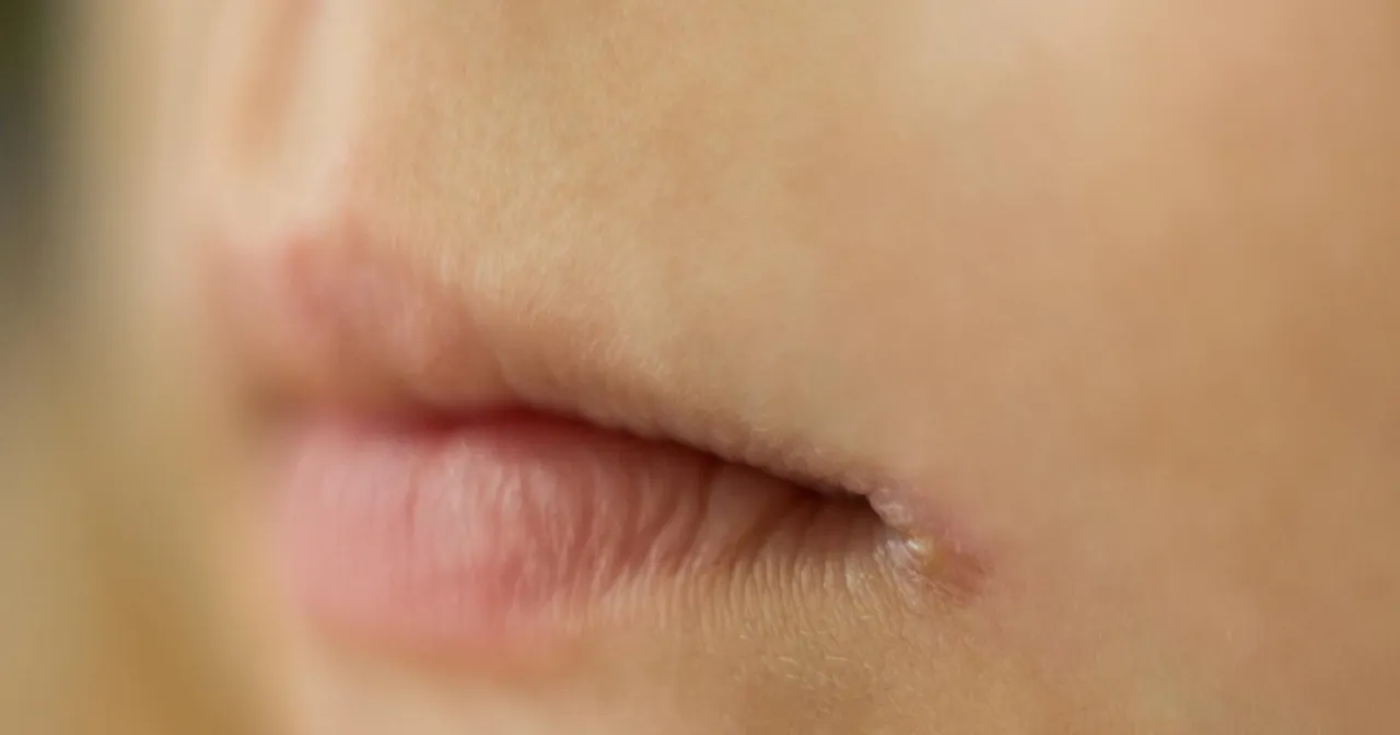 zajady w kącikach ust grzybica