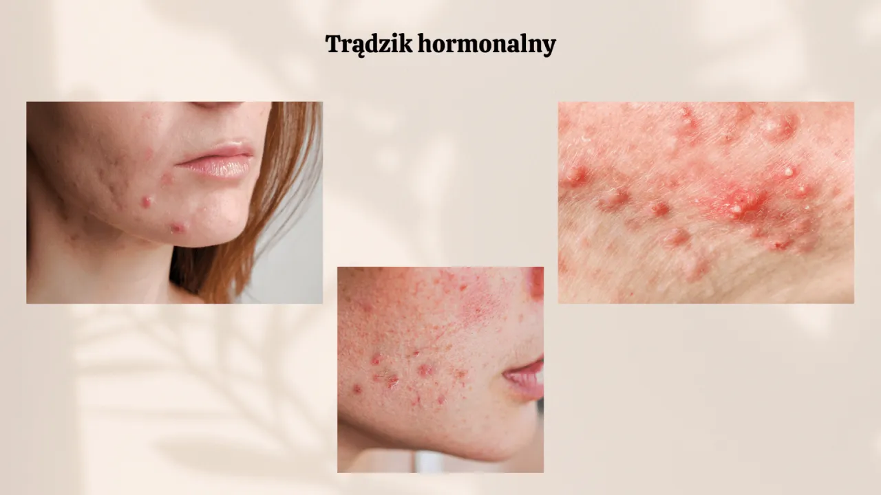 Dieta a trądzik