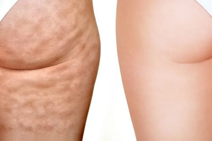 domowe sposoby na cellulit