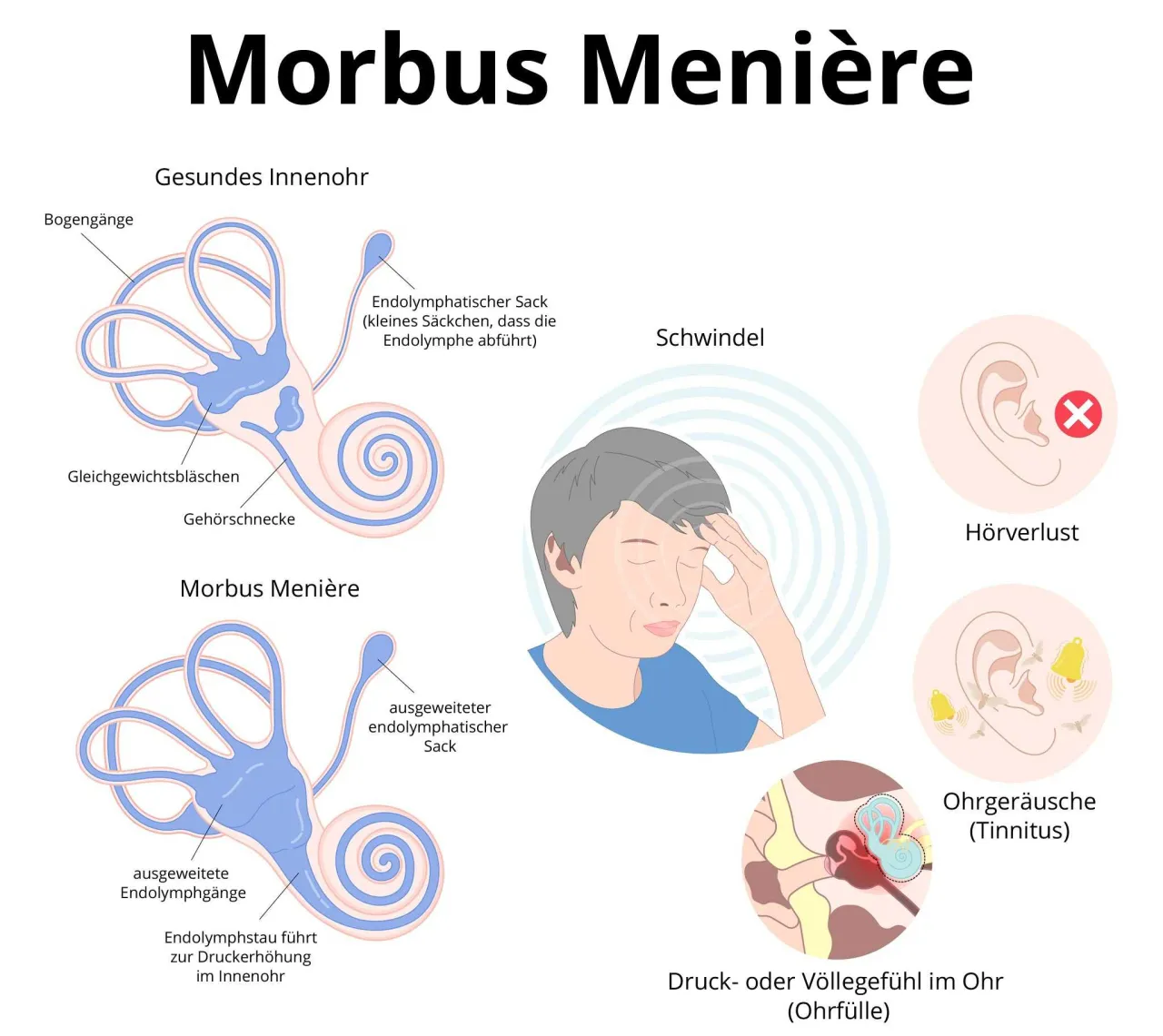 Morbus Meni&egrave;re Innenohr Schema