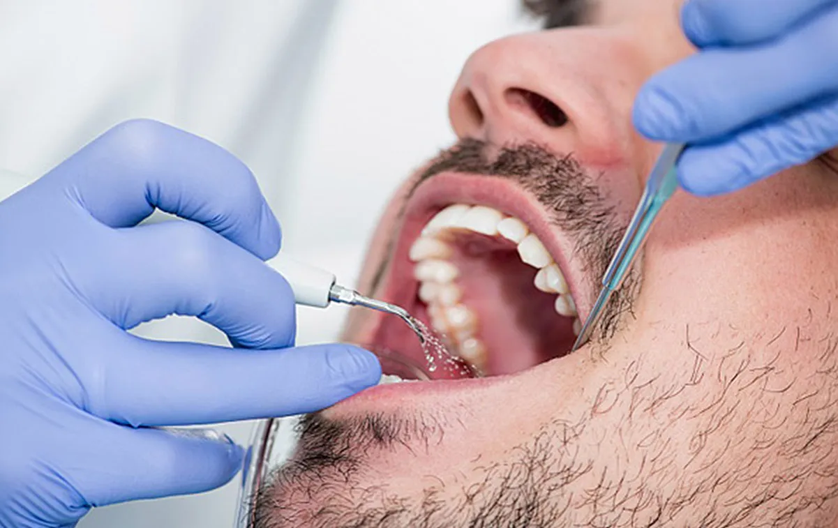 dentysta usuwanie kamienia nazębnego skaling