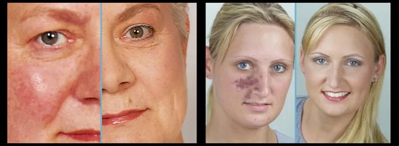 Camouflage Make-up Vorher Nachher Hautanomalien