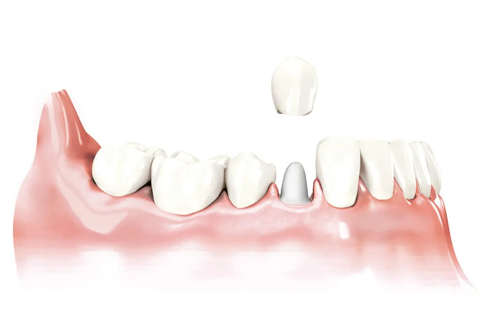 korona na ząb przedni estetyka