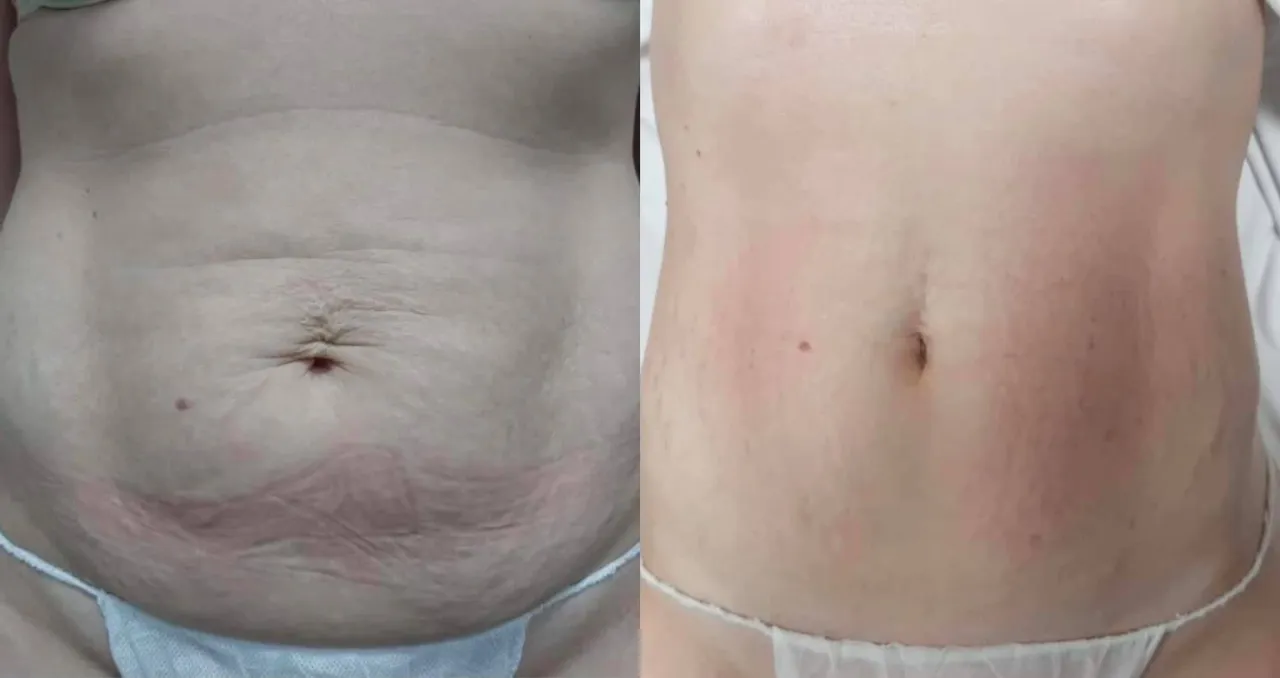 profesjonalne zabiegi na cellulit brzucha endermologia fala uderzeniowa