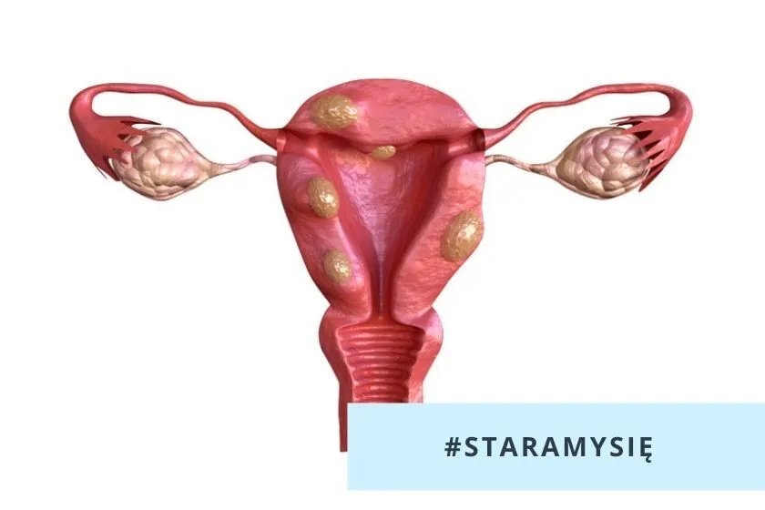 Objawy mięśniak&oacute;w macicy po menopauzie