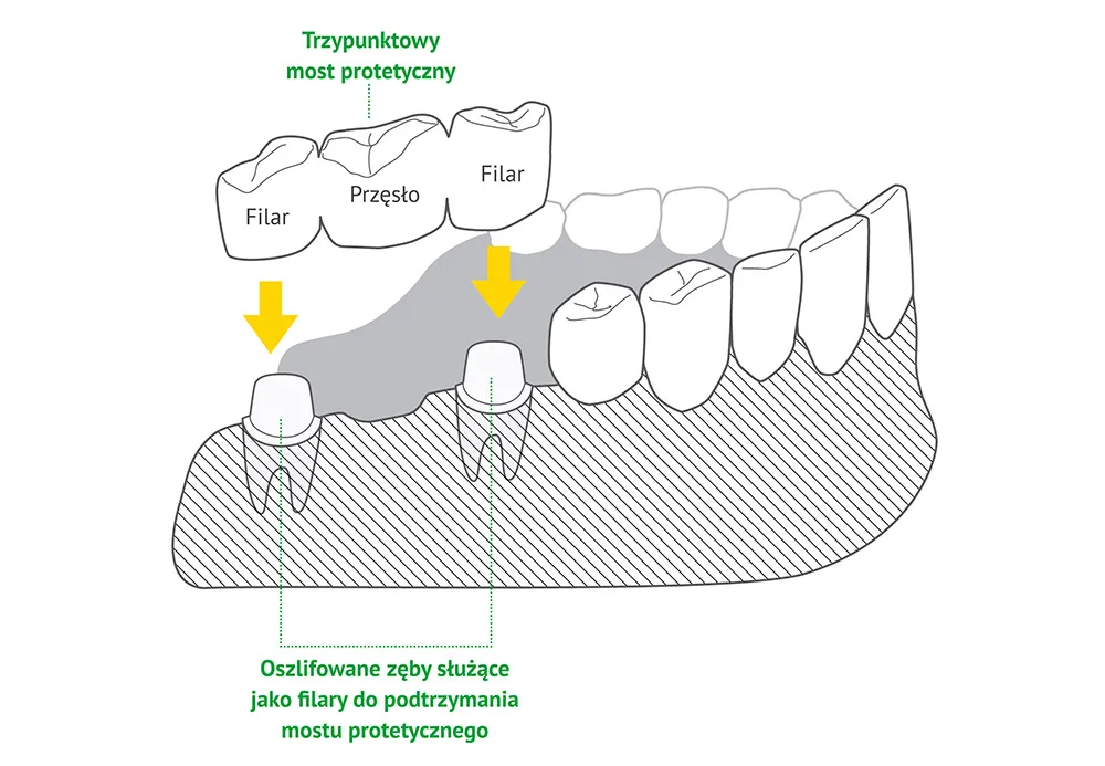 most protetyczny schemat