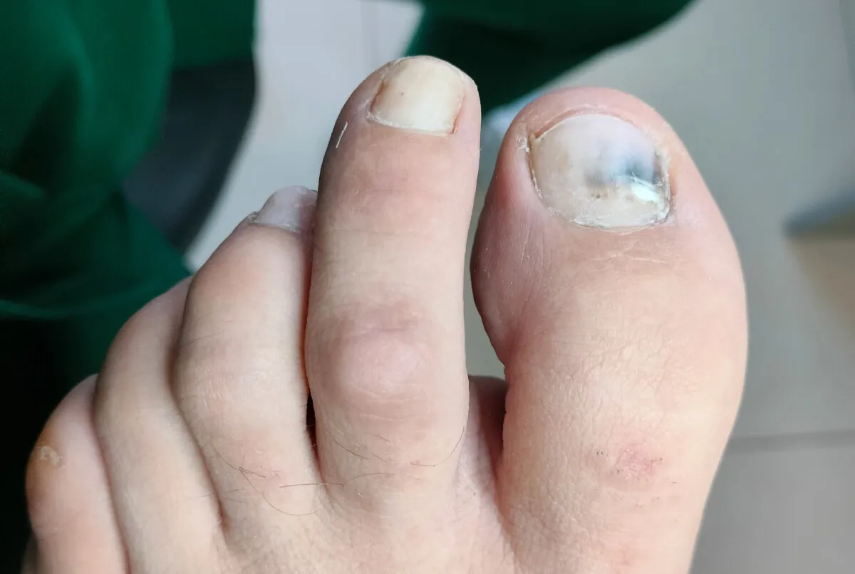 kiedy krwiak pod paznokciem do lekarza