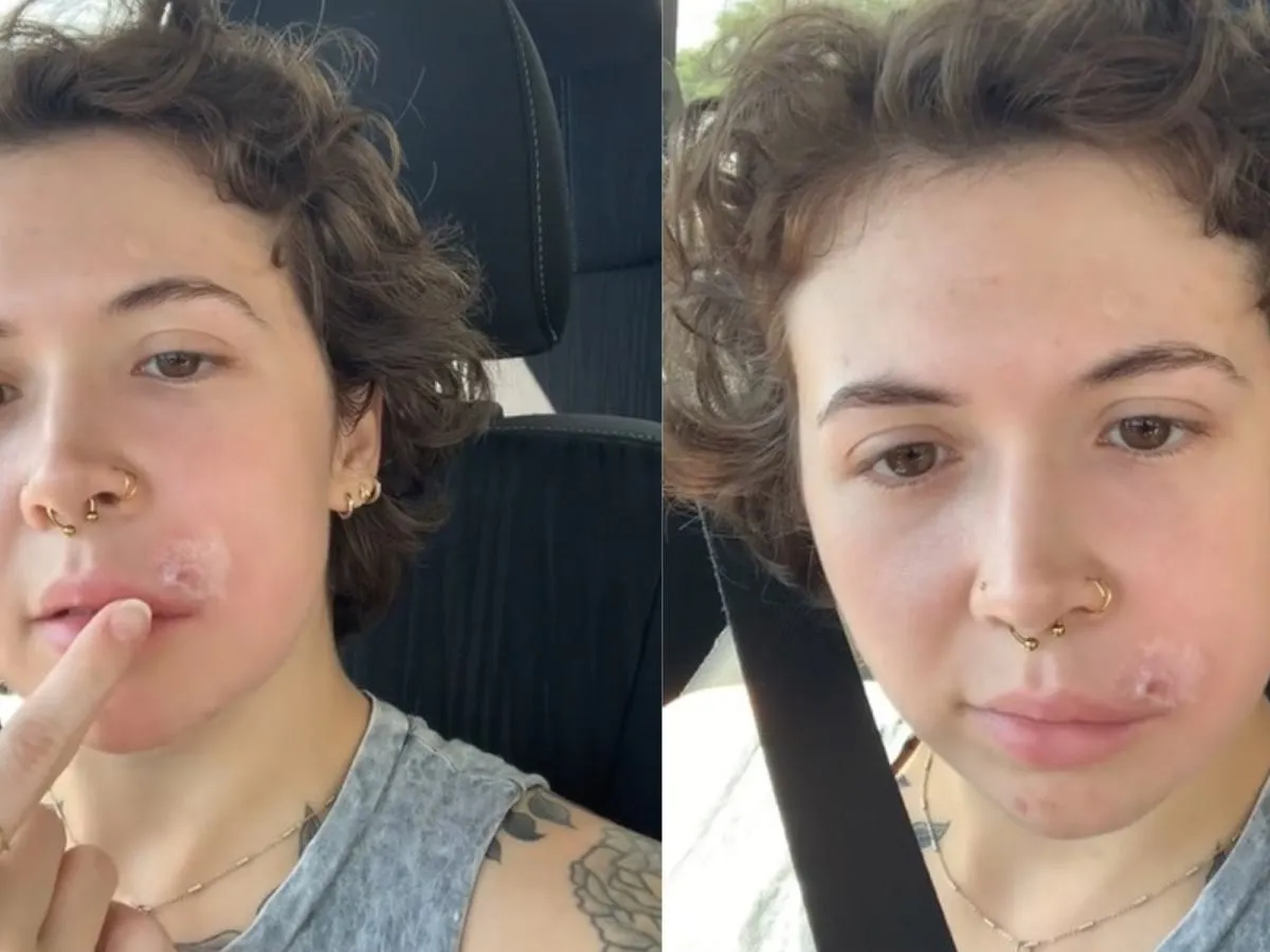 Skóra z bliznami potrądzikowymi